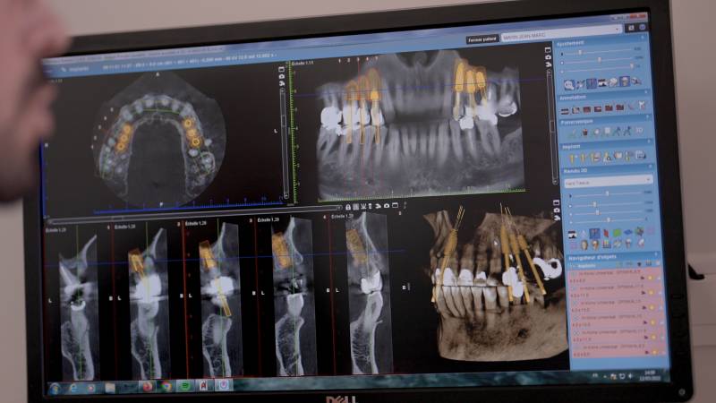 Scanner 3D permettant le diagnostic de la pose d'implant