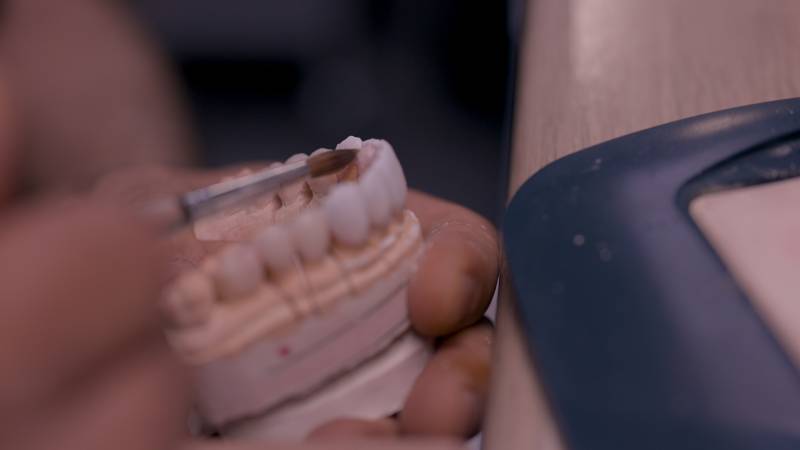 Facettes dentaires en céramique pour masquer les taches, les dents ébréchées ou les espacements visibles à Marseille dans les Bouches du Rhone