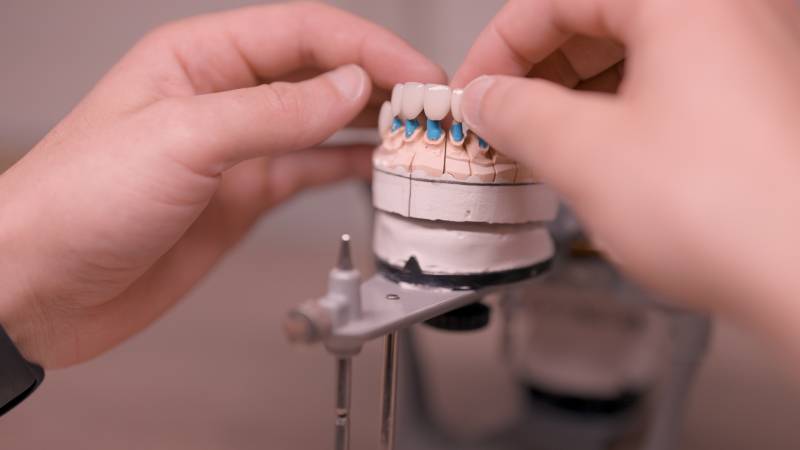 Réalisation d'un bridge dentaire céramique par un prothésiste dentaire expert