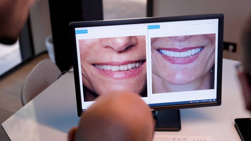 Avant-Après esthétique du sourire